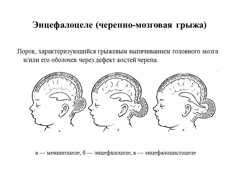 Энцефалоцеле (черепно-мозговая грыжа)   Порок, характеризующийся грыжевым выпячиванием головного мозга и/или его оболочек